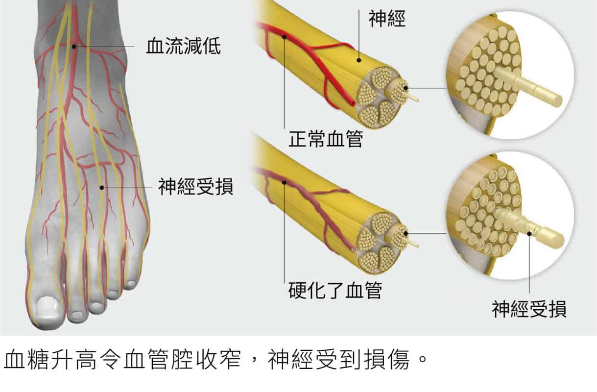足部血液循環與神經健康評估 足部血液循環與神經健康評估