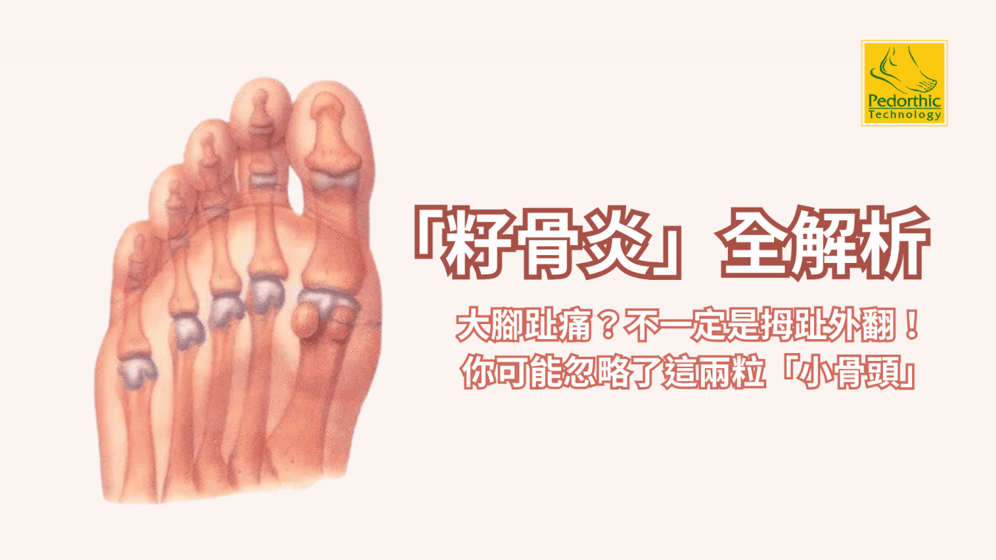 大腳趾底部痛？別只怪拇趾外翻，可能是「籽骨炎」！
